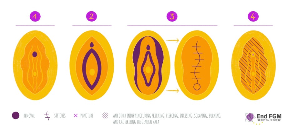 FGMの4つのパターン