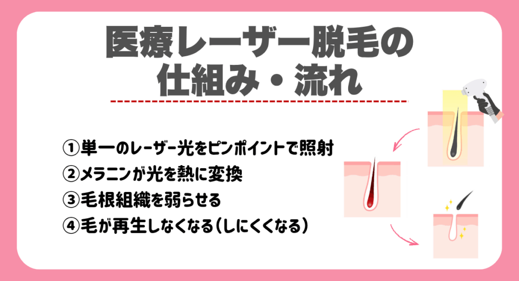 医療レーザー脱毛の仕組み・流れ