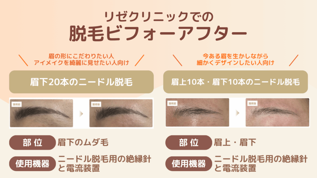 リゼクリニックでの脱毛ビフォーアフター