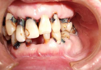 出典：筋ジストロフィーってどんな病気？（国立病院機構大阪刀根山医療センター）