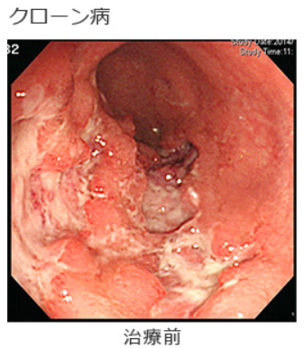 出典:クローン病 | 国立成育医療研究センター